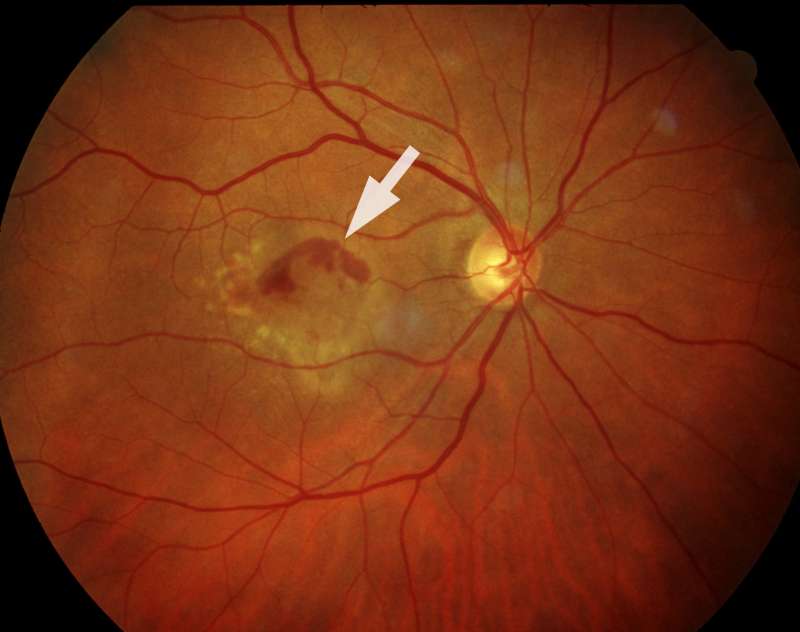 Makula bei Altersabhängiger feuchter Makuladegeneration