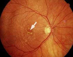 Altersbedingte trockene Makuladegeneration
